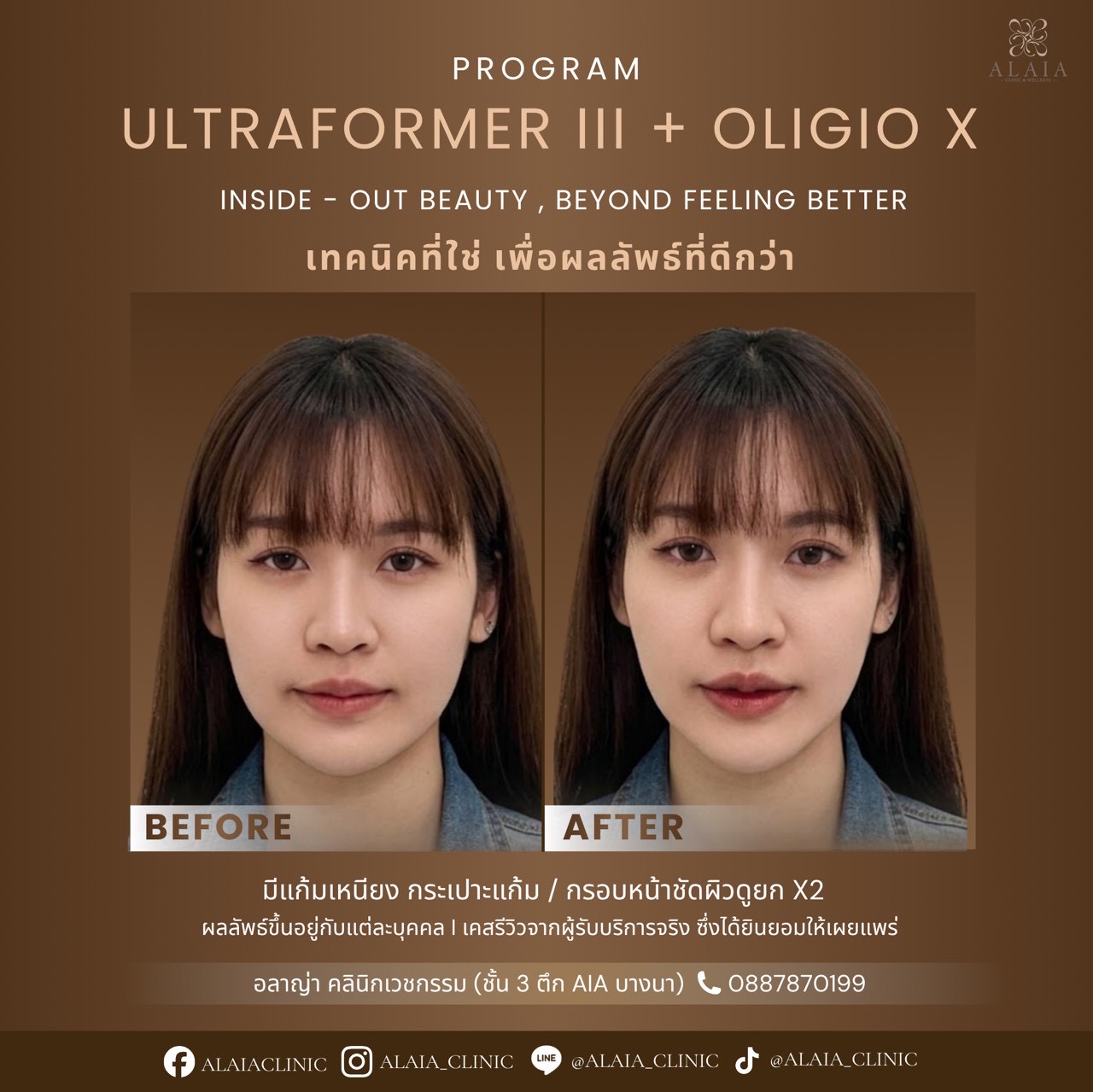 Ultraformer III Review Result 3